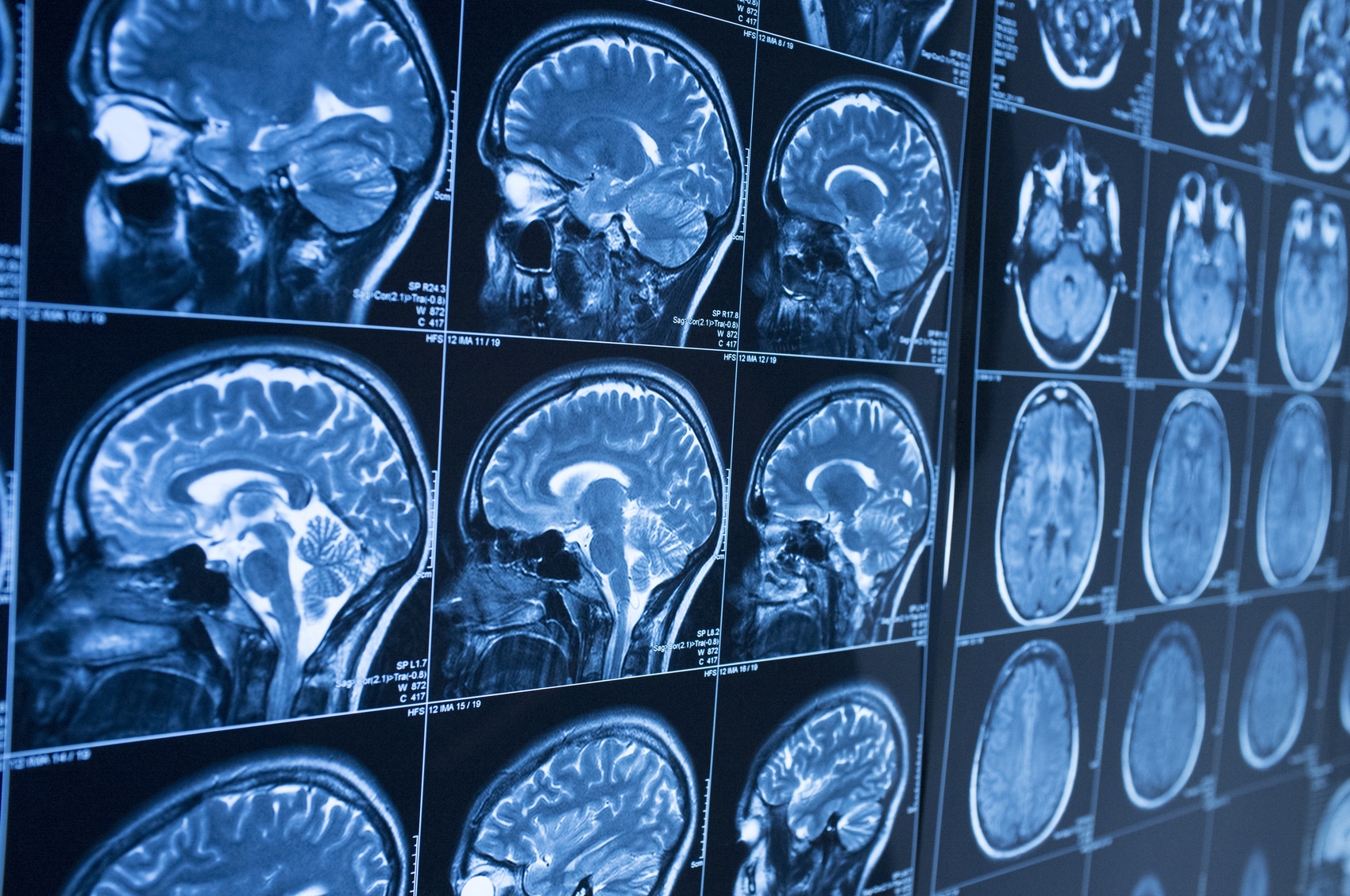brain injury