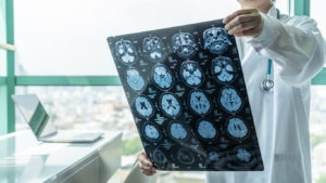 Brain injury