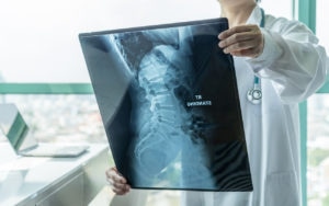 doctor looking at spinal cord x ray in nyc