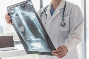 broken bones