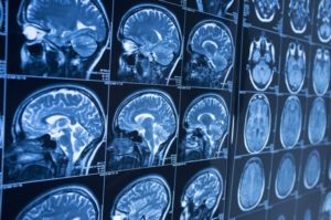 Overview of Brain Injuries 