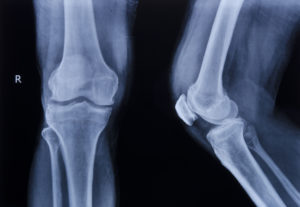 Fractures and Joint Injuries