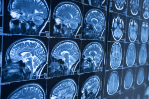 ¿Qué Es Una Hemorragia Cerebral?