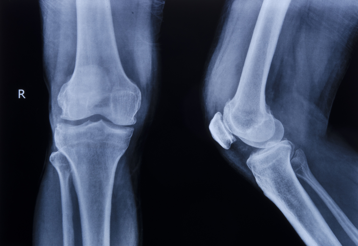 What’s the Average Settlement for Slip and Fall Knee Injuries?