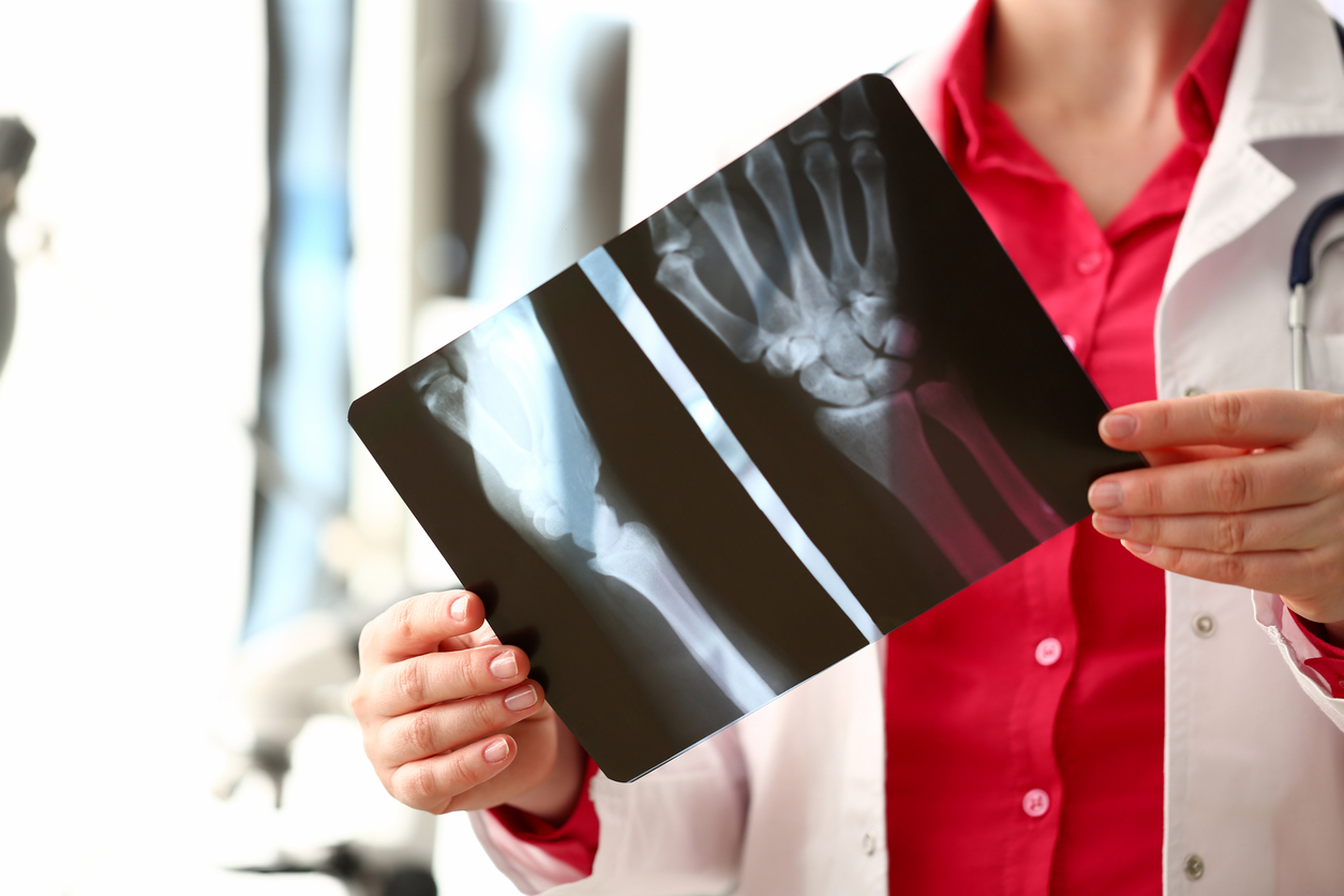 How Long Does It Take Bones To Heal?
