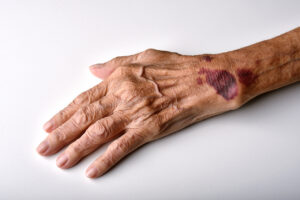 What Is a Hematoma?