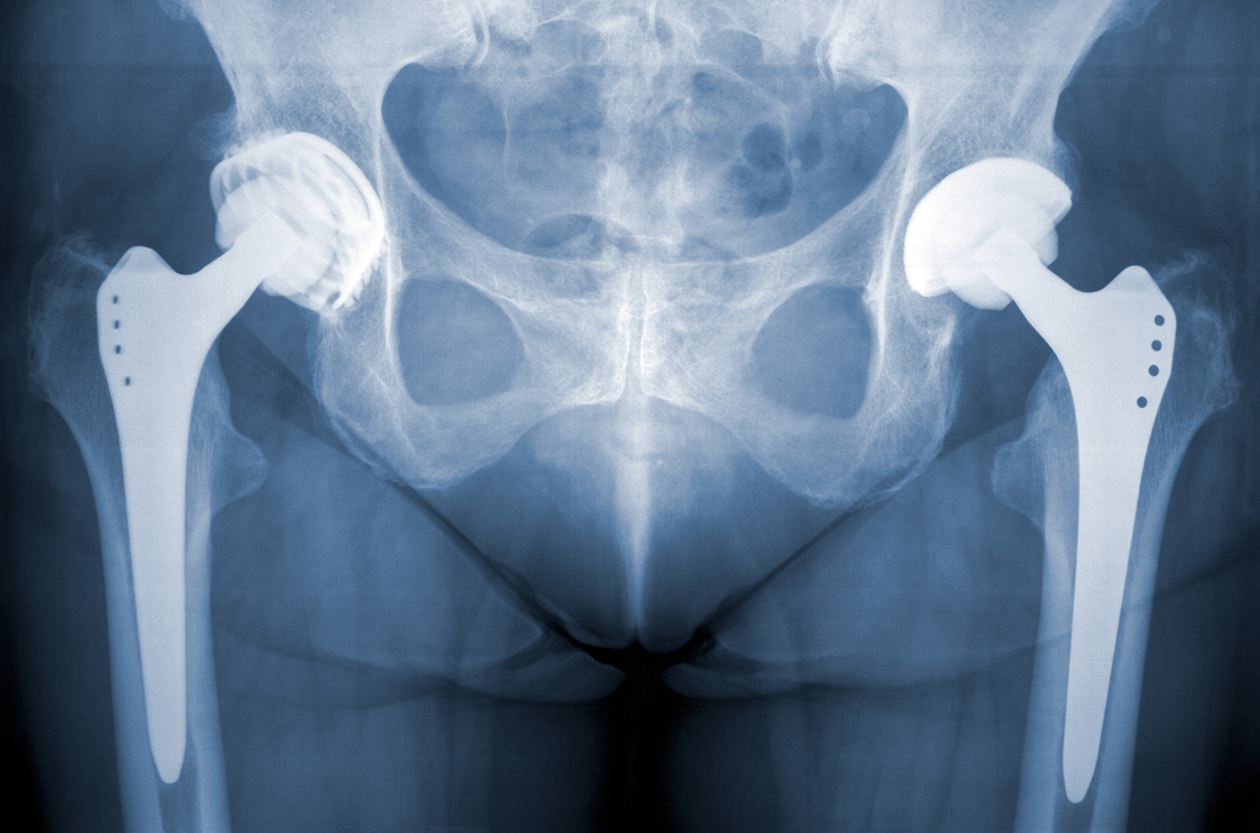 Understanding Hip Fractures: Types, Causes, & Treatment